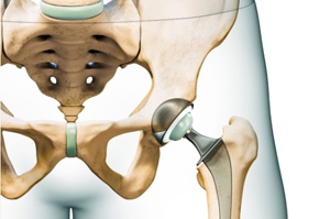 Direct Anterior Hip Replacement: Why a Muscle-Sparing Approach Matters