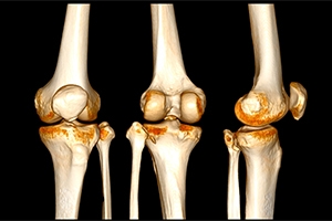 From Scan to Surgery: How Knee Replacement Is Planned Before You Enter the OR