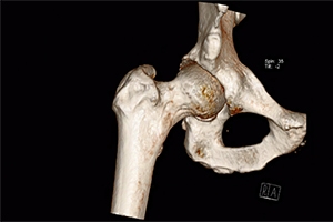Why Surgeons Use CT-Based Planning for Direct Anterior Hip Replacement